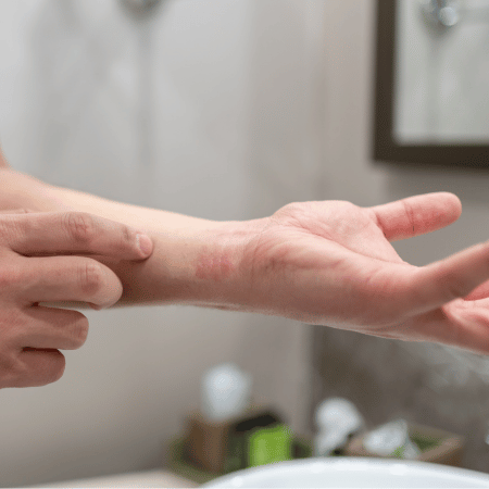 Représentation de la peau atopique