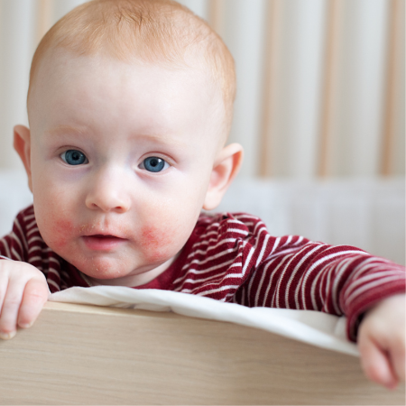 Bébé peau atopique